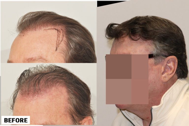before-after-left