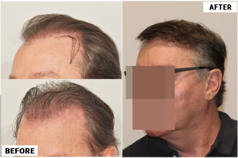before-after-left3