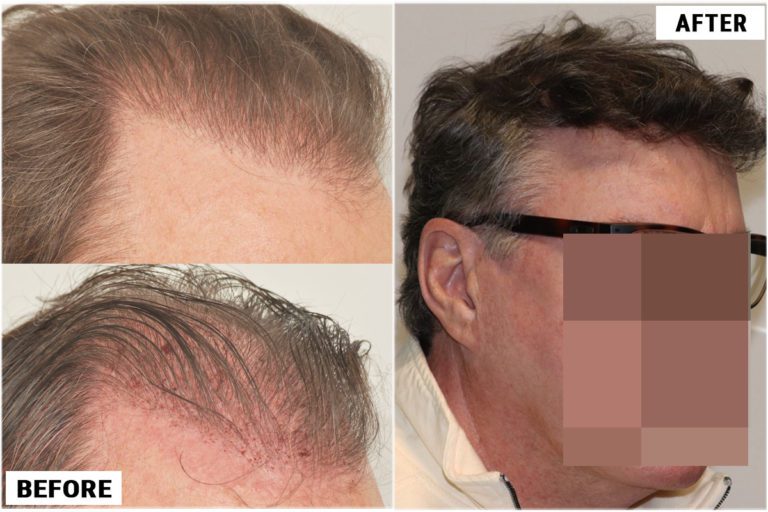before-after-right