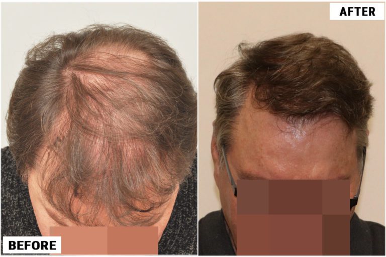 before-after-top