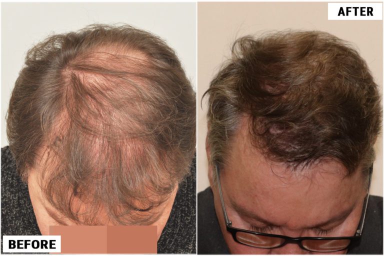 before-after-top2
