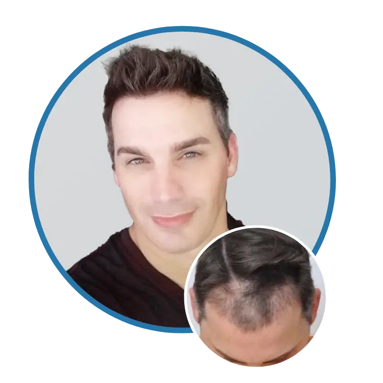 Hair Restoration Results