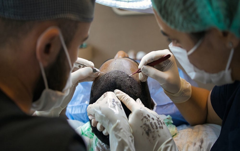 A sample of hair transplantation.