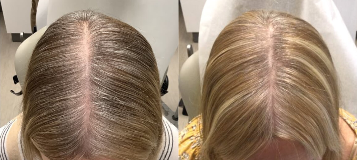 Alma TED before and after on a female patient