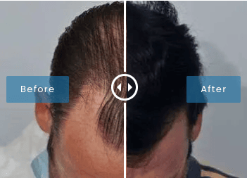 Before & After Hair Transplant Procedure