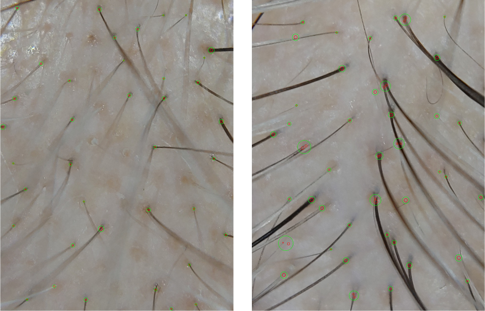 Alma TED restoring the hair folicles: before and after