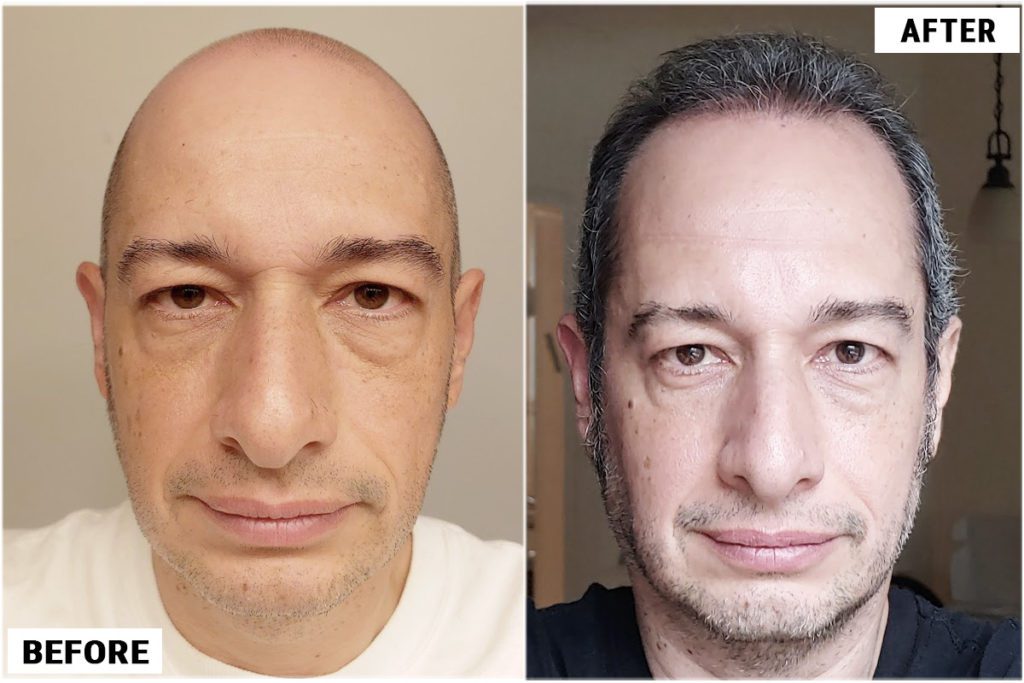 Hair Transplant 3950 grafts FUE