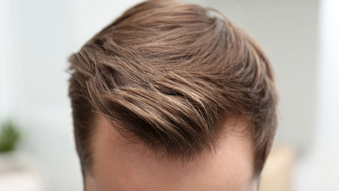 A man with a full head of hair after a successful hair transplant