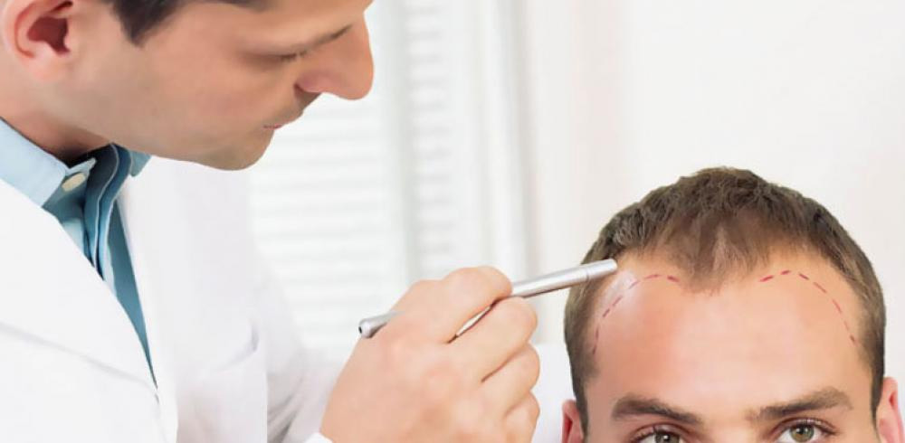 A doctor and patient consultation discussing a hair transplant procedure