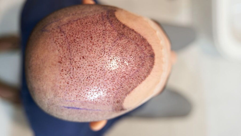 A man with a full head of hair before and after a hair transplant