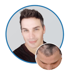 Patient before and after hair transplant