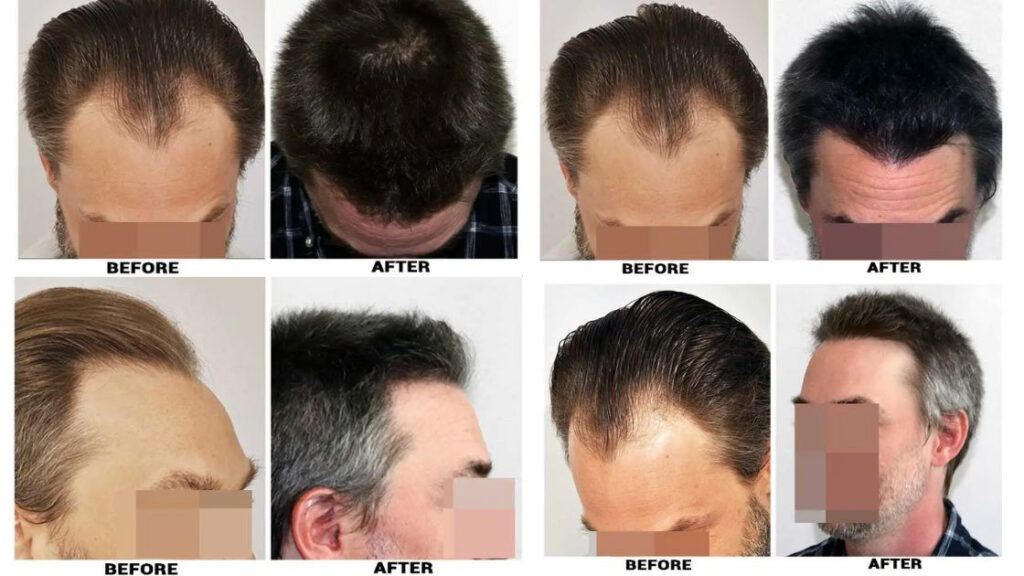 A close-up image of a scalp with newly transplanted hair follicles using the no shave FUE technique for hair restoration.