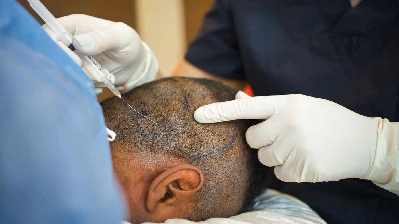 A person receiving a traditional hair transplant