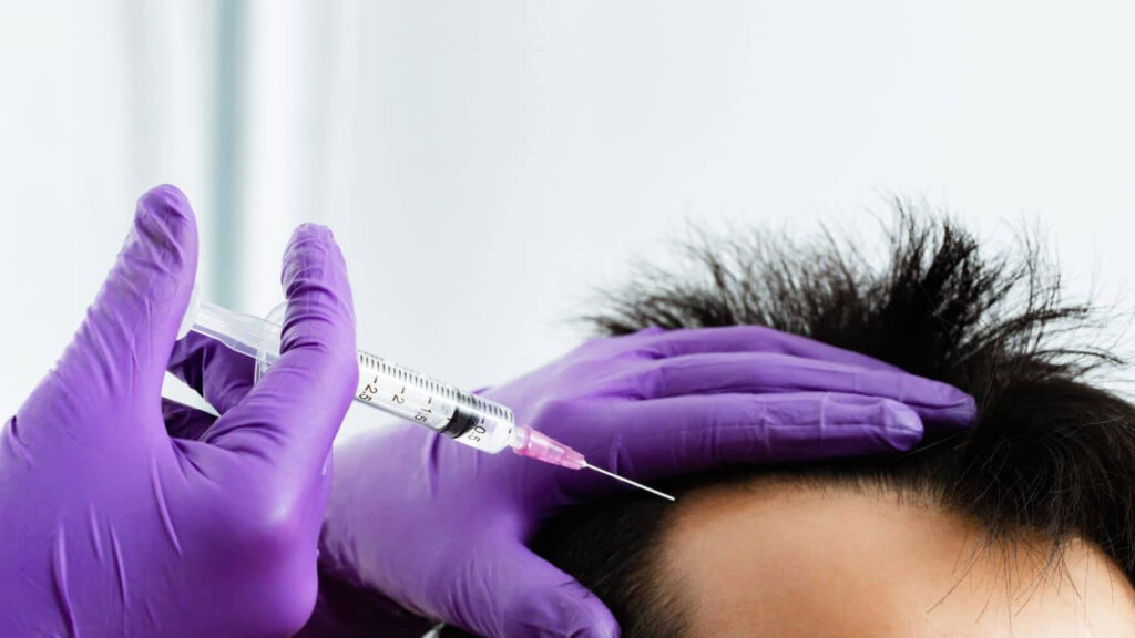 A person receiving a stem cell hair treatment