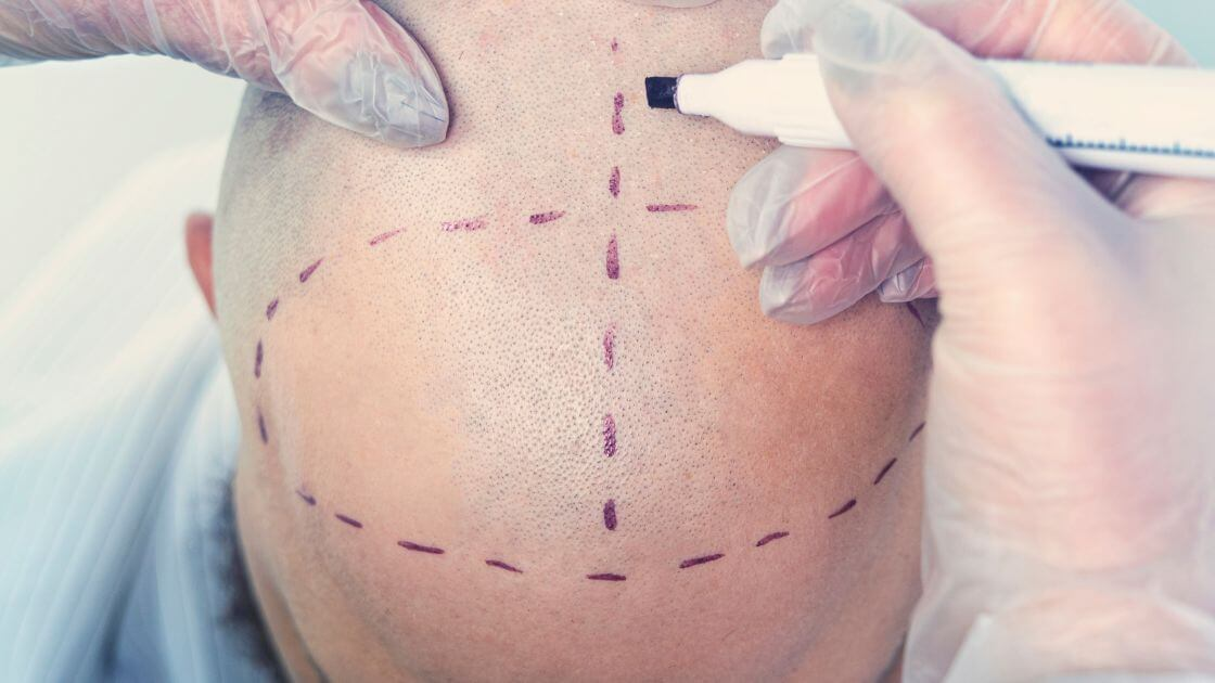 A man getting a hair transplant procedure