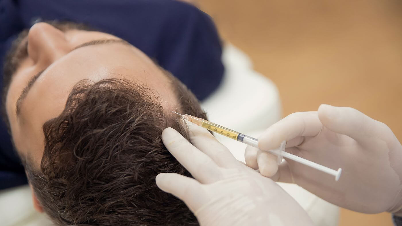 PRP can be combined with microneedling to stimulate hair growth