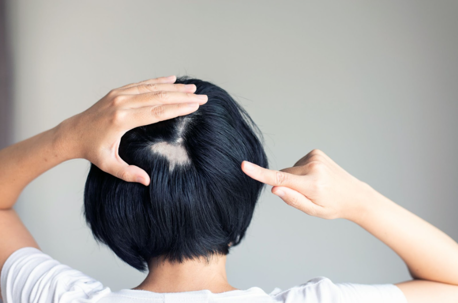 A person with short, black hair, using their hands to point out and reveal a small, round bald patch on the back of their head.