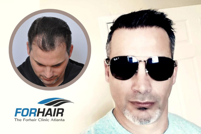 Jude Hair Transplant Results