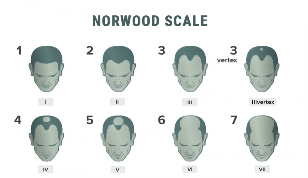 Norwood Scale types