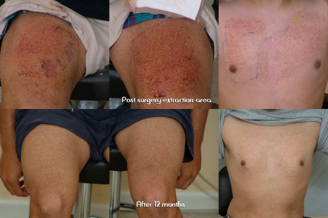 before and after post body hair transplant healing