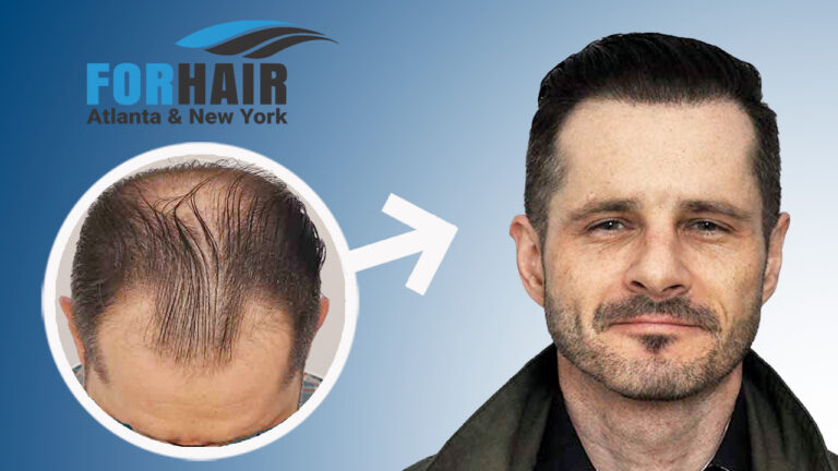 Patient Results with Dense Hairline