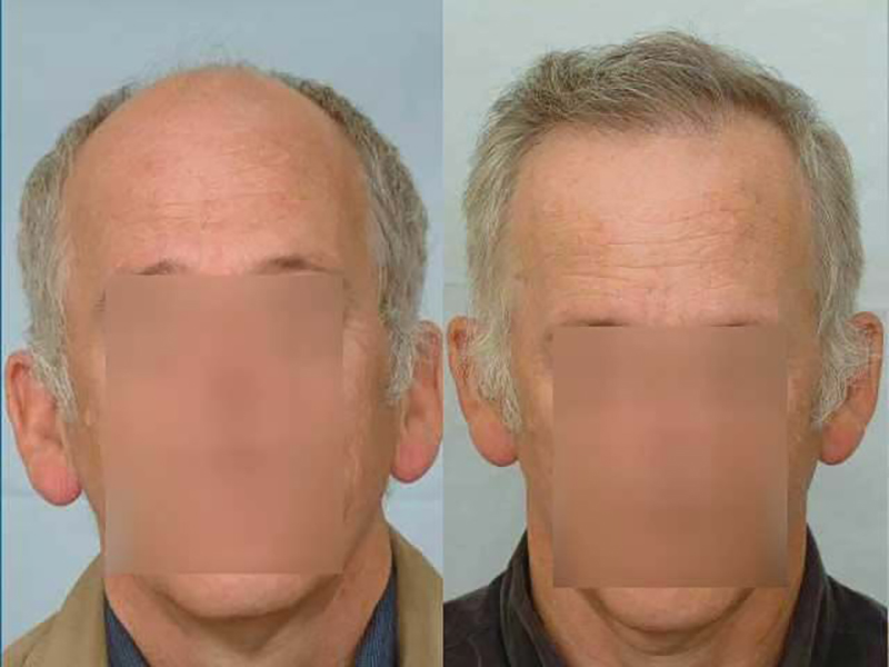 Hair Transplant 6102 grafts FUE