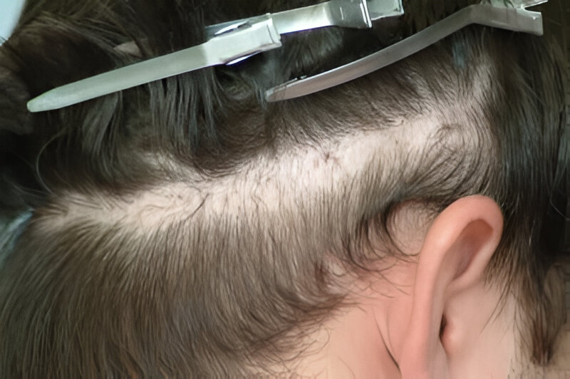 Before scar repair right view