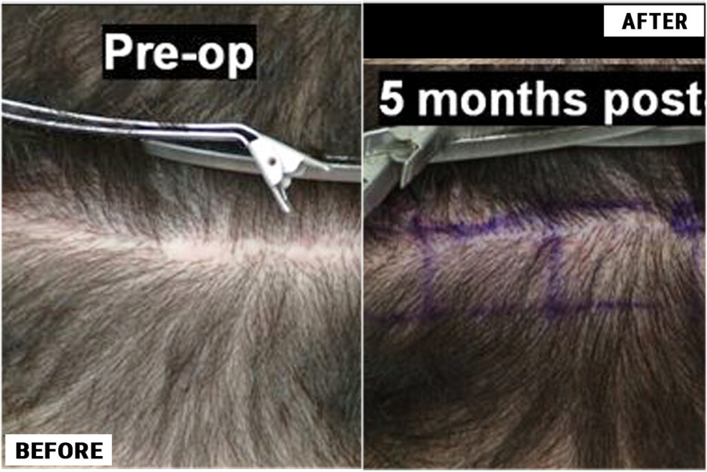 Scar Repair 130 grafts FUE