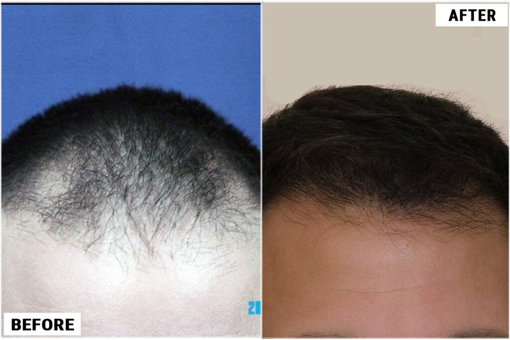 Hair Transplant 1101 grafts FUE