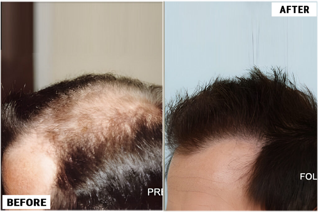 Hair Transplant 1500 grafts FUE