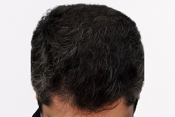 Hair Transplant 1915 grafts FUE