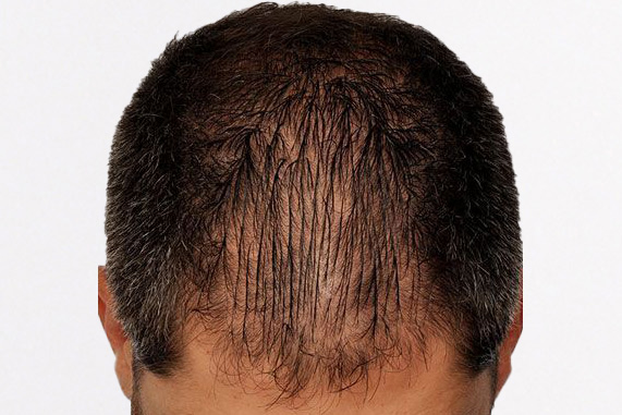 Hair Transplant 1915 grafts FUE