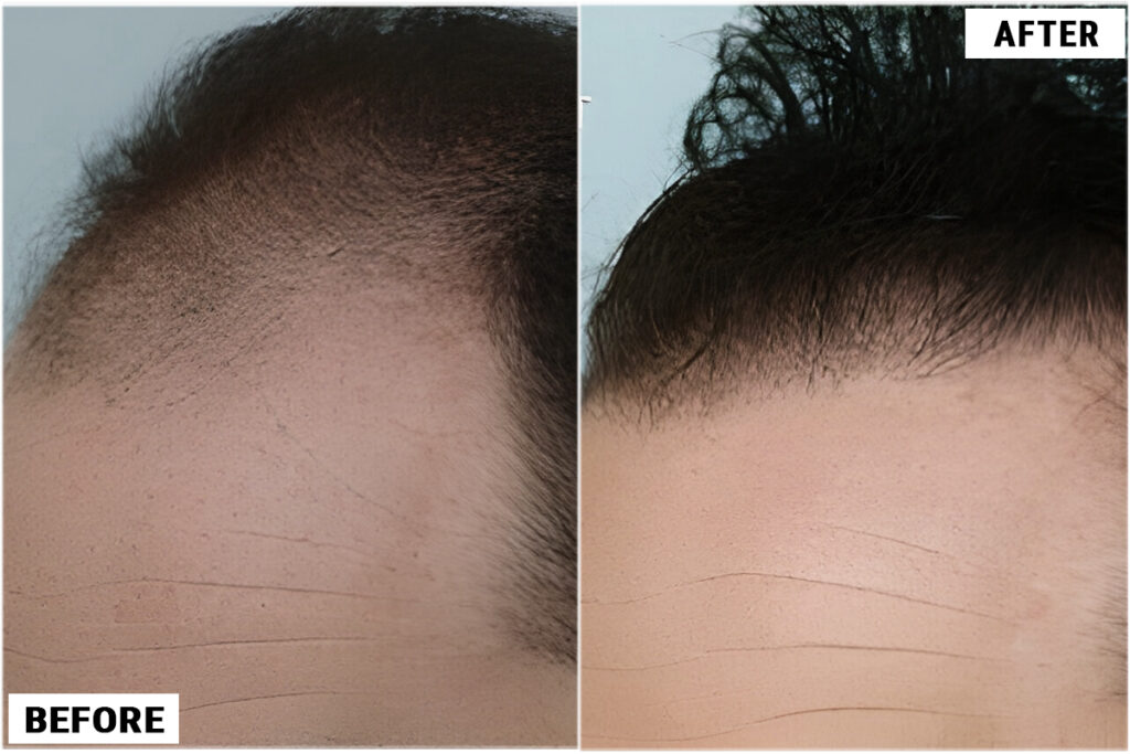 Hair Transplant 2301 grafts FUE