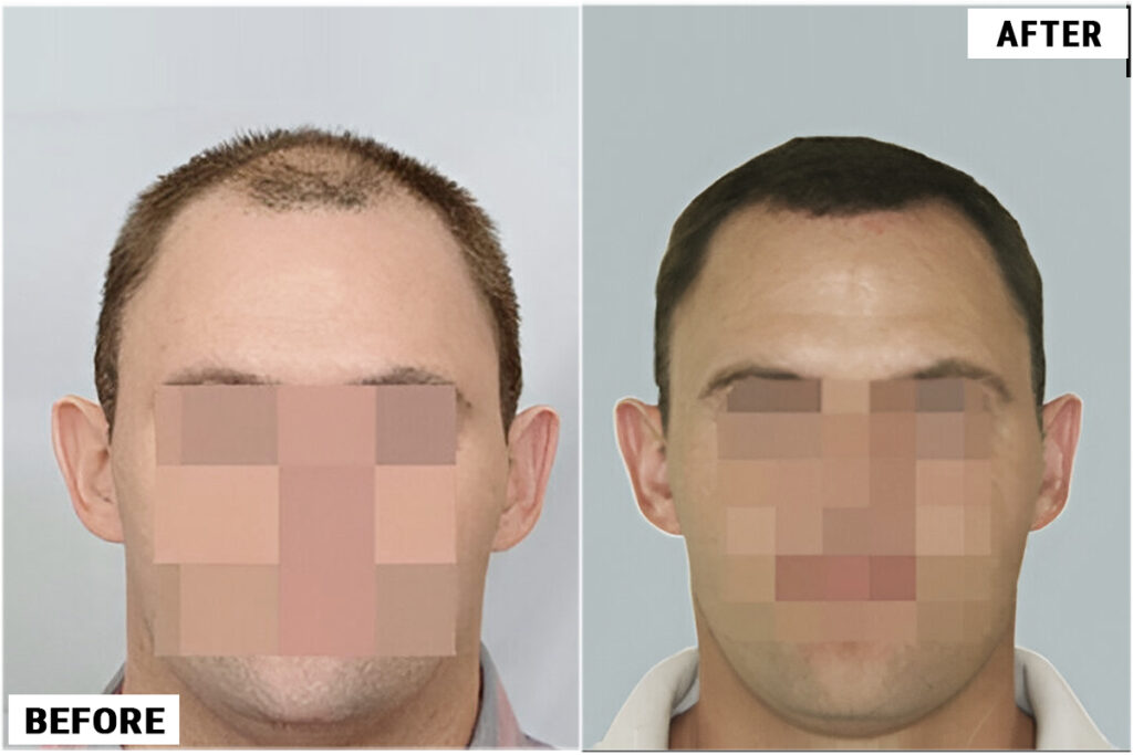 Patient UJT before & after FUE results comparison front