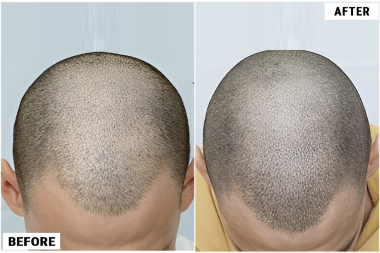 Patient AAC before & after FUE results top view comparison