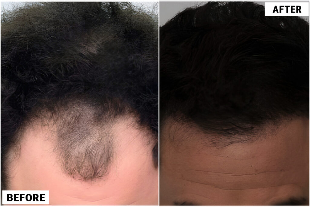 Hair Transplant 2373 grafts FUE