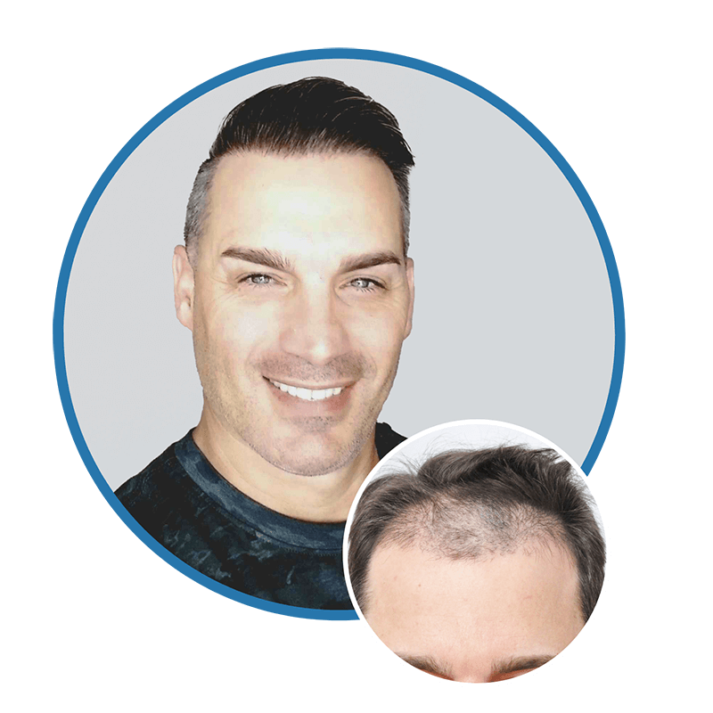FUE before and after patient results