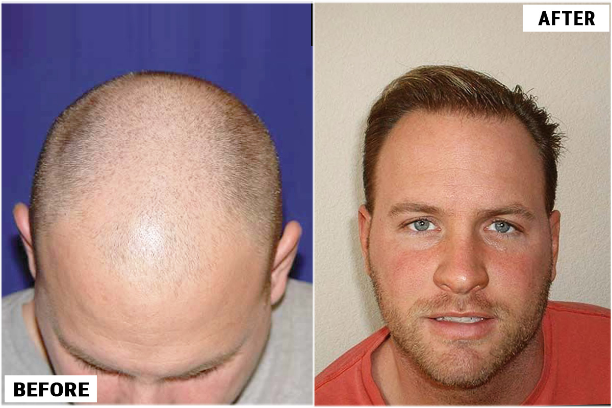 Patient TKA before & after FUE results featured photo
