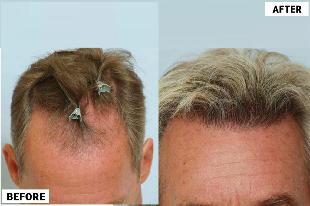Hair Transplant 2470 grafts FUE