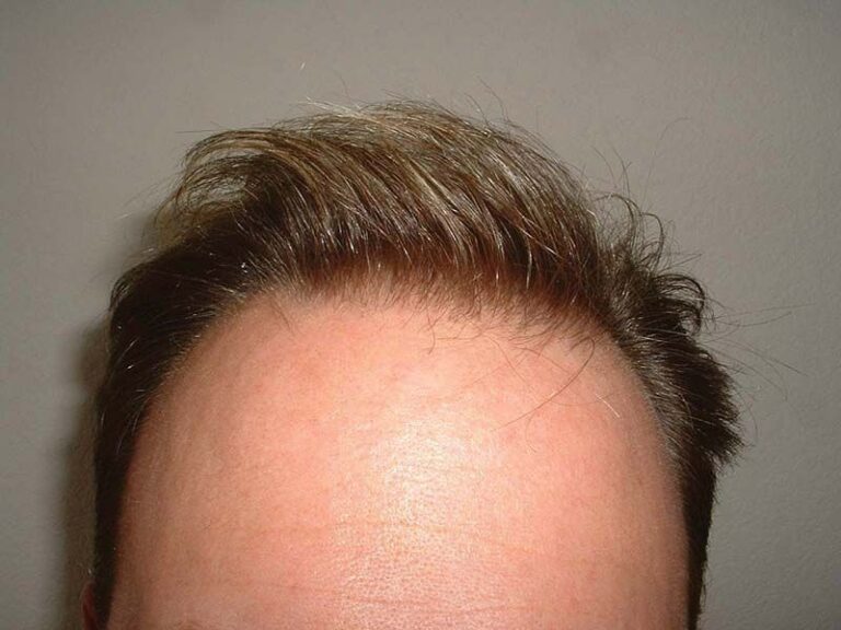 Patient TKA before & after 7 months FUE results front hairline close-up 3
