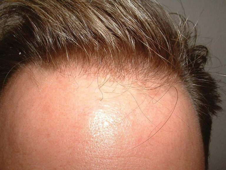 Patient TKA before & after 7 months FUE results front hairline close-up 4
