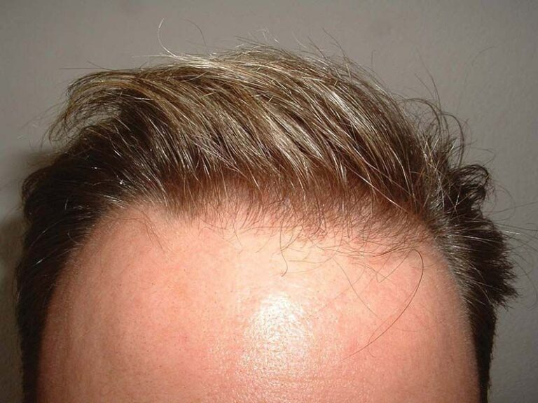 Patient TKA before & after 7 months FUE results front hairline close-up 5