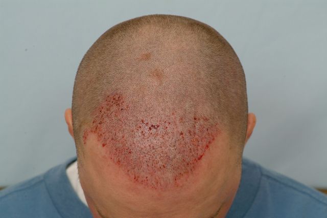 Patient BLD immediate post-op FUE top view