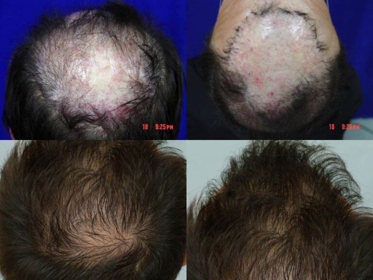 Patient DRS before & after FUE results collage 5
