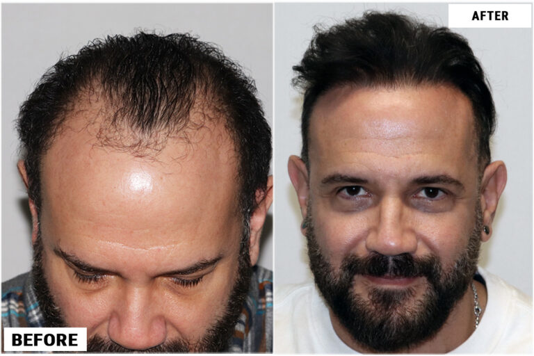 Patient RRW before & after FUE results front comparison 2