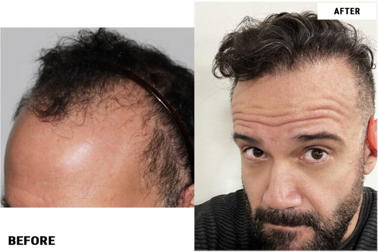 Patient RRW before & after FUE results left side comparison 2