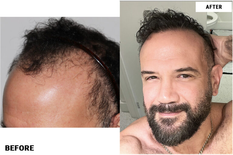 Patient RRW before & after FUE results left side comparison 3