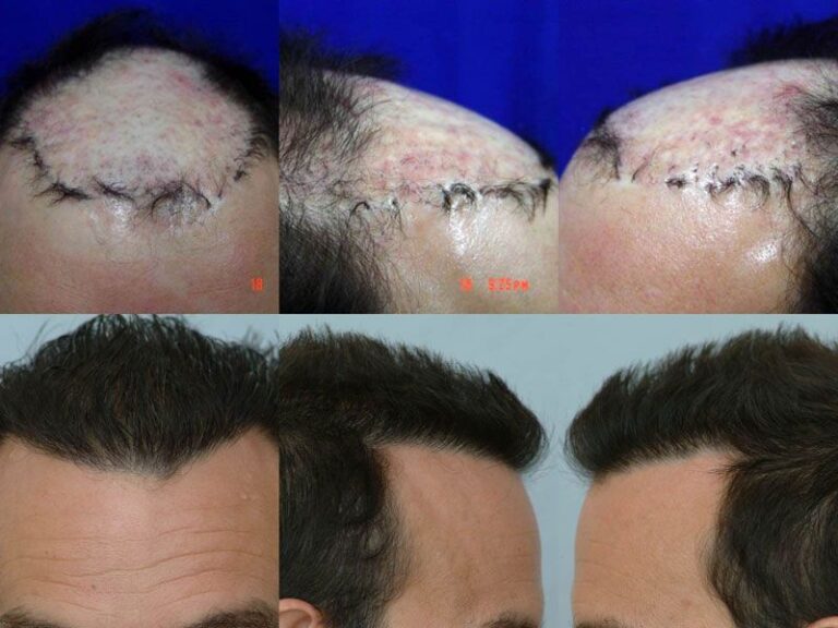 Patient DRS before & after FUE results collage 1