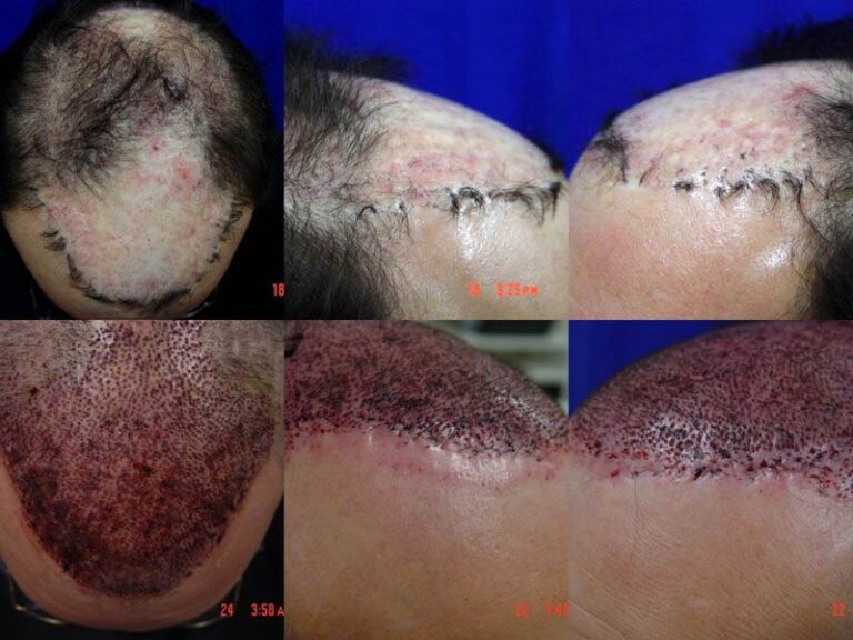 Patient DRS before & after FUE results collage 2