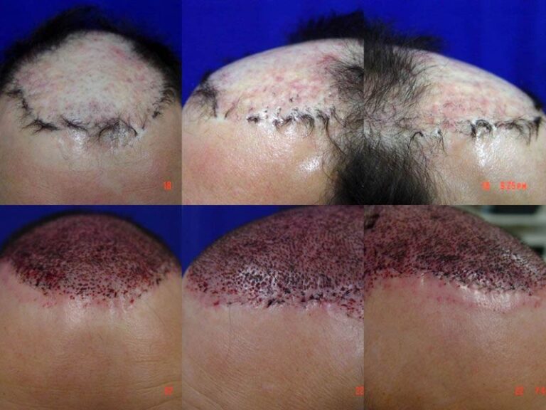 Patient DRS before & after FUE results collage 3